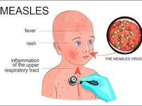 Measles Outbreak in West Texas: What You Need to Know